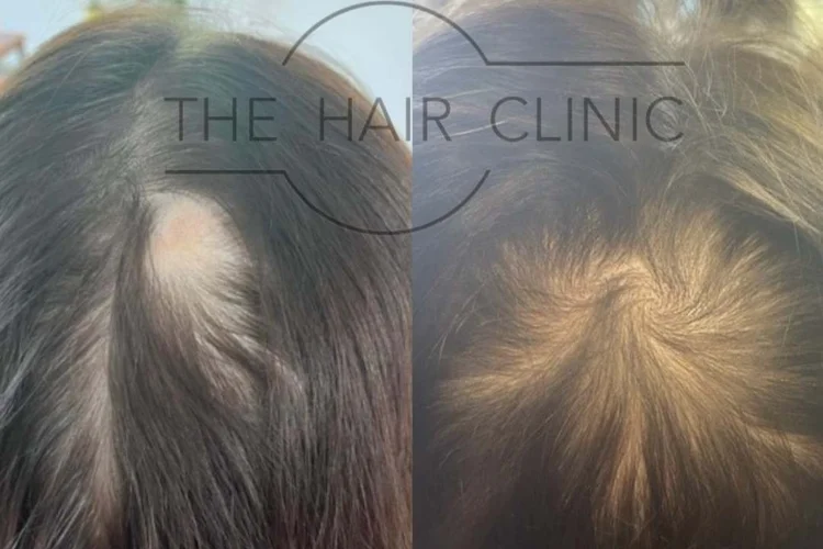 Hair+Clinic+NZ+Before+&+After+PRP+Hair+Regrowth+treatment+women