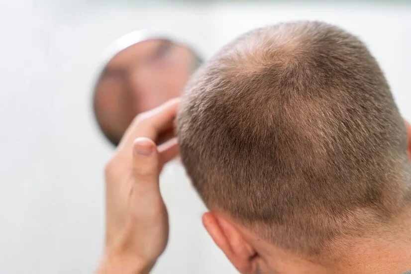 Man examining thinning hair at the crown while looking in a mirror