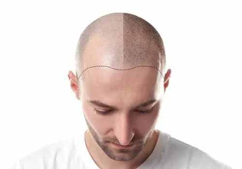Man illustrating hair restoration and scalp health concept with half shaved scalp and visible hairline outline