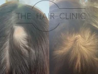 Hair+Clinic+NZ+Before+&+After+PRP+Hair+Regrowth+treatment+women
